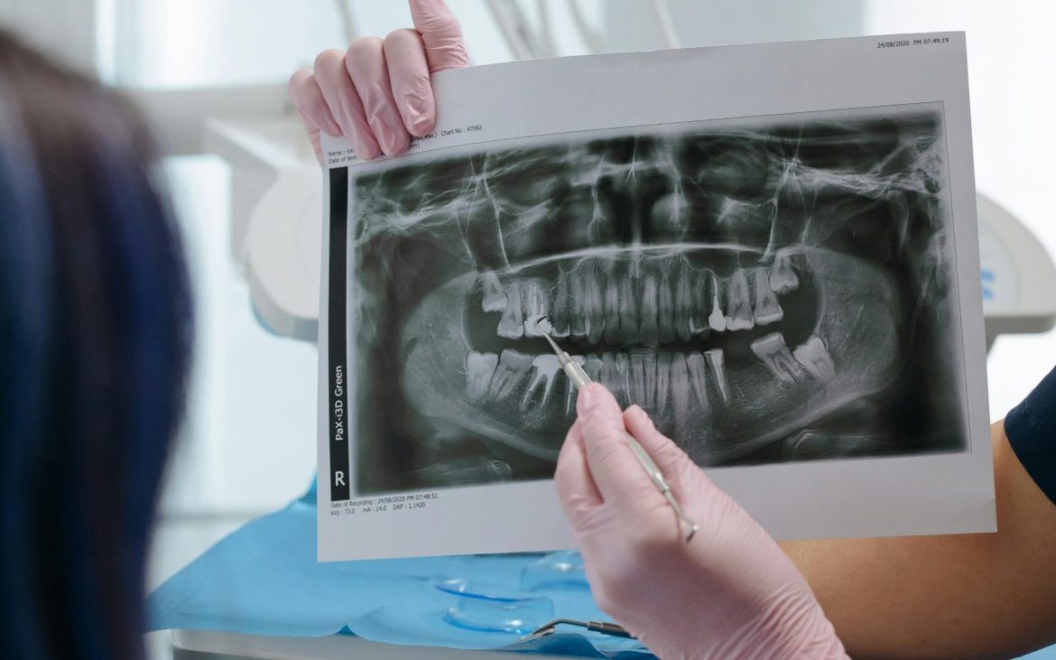 Rendgenski snimak zuba